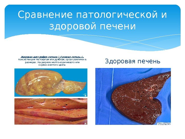Сравнение патологической и здоровой печени Жировая дистрофия печени ( «Гусиная печень» ).  Консистенция тестоватая или