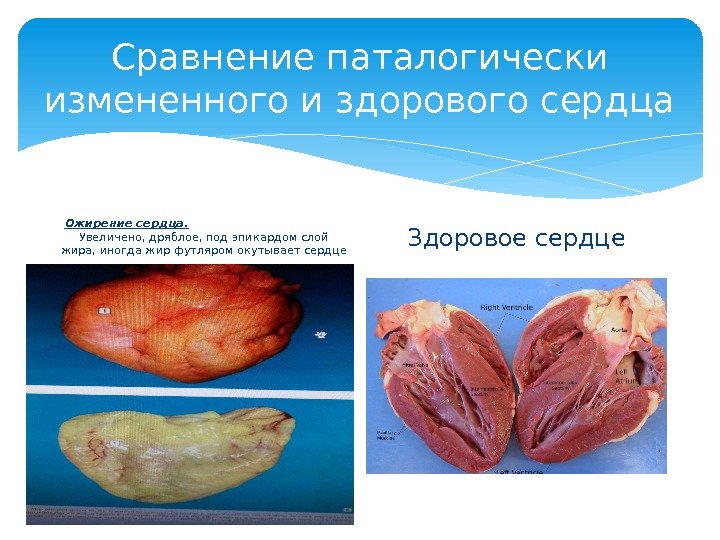 Сравнение паталогически измененного и здорового сердца Ожирение сердца.    Увеличено, дряблое, под эпикардом слой