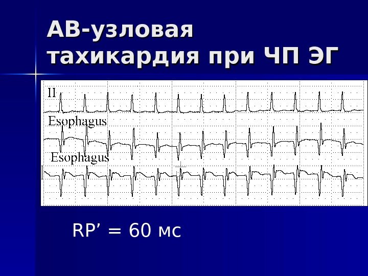 АВ-узловая тахикардия при ЧП ЭГ RP’ = 60 мс 