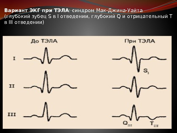 Тэла экг картина