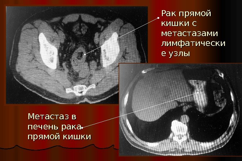 Рак прямой кишки с метастазами лимфатически е узлы Метастаз в печень рака прямой кишки 