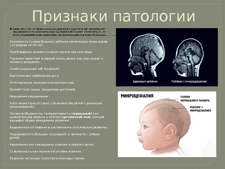 Люди с микроцефалией фото