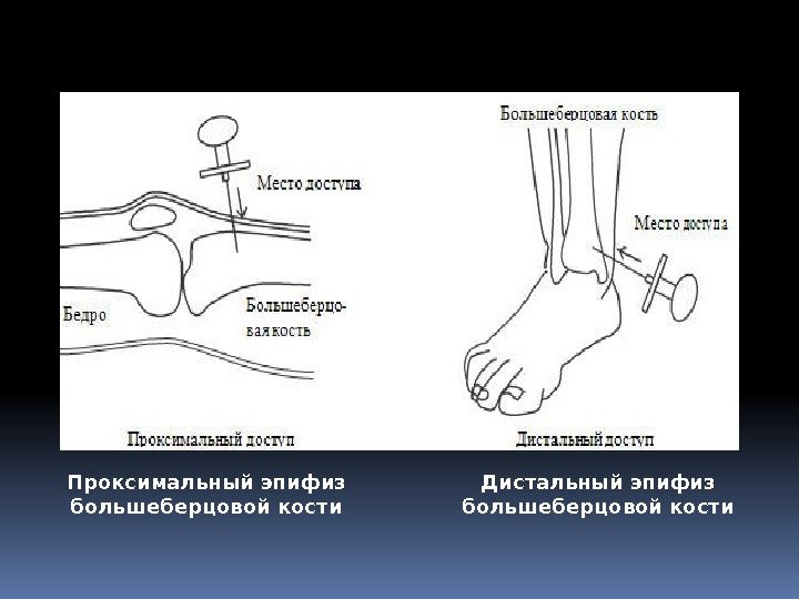 Дистальный конец большеберцовой кости. Дистальный эпифиз большеберцовой кости. Дистальный отдел большеберцовой кости. Перелом дистального эпифиза большеберцовой кости. Большеберцовая кость проксимальный эпифиз.
