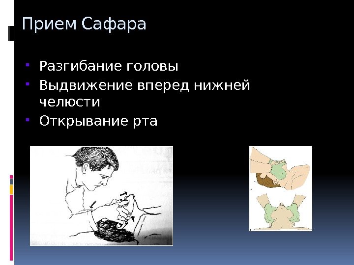 Тройной прием алгоритм. Тройной прием Сафара алгоритм. Продемонстрируйте тройной прием Сафара.