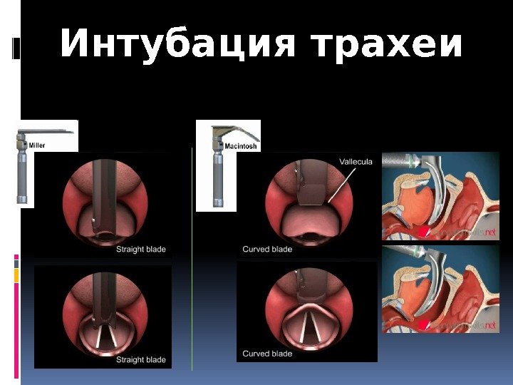 Интубация трахеи презентация