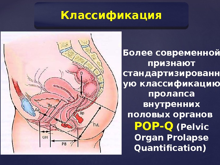 Классификация Более современной признают стандартизированн ую классификацию пролапса внутренних половых органов POP-Q (Pelvic Organ