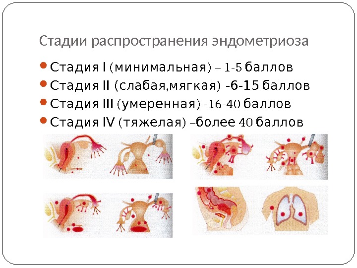 Наружный генитальный эндометриоз фото