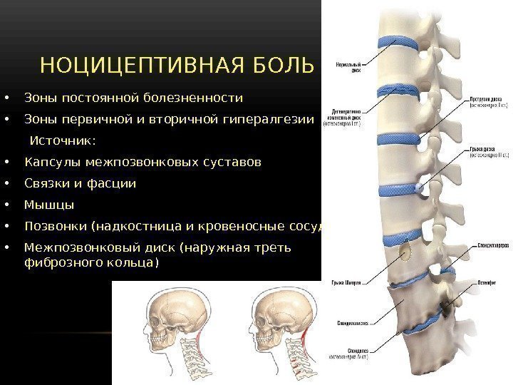  • Зоны постоянной болезненности • Зоны первичной и вторичной гипералгезии  Источник: 