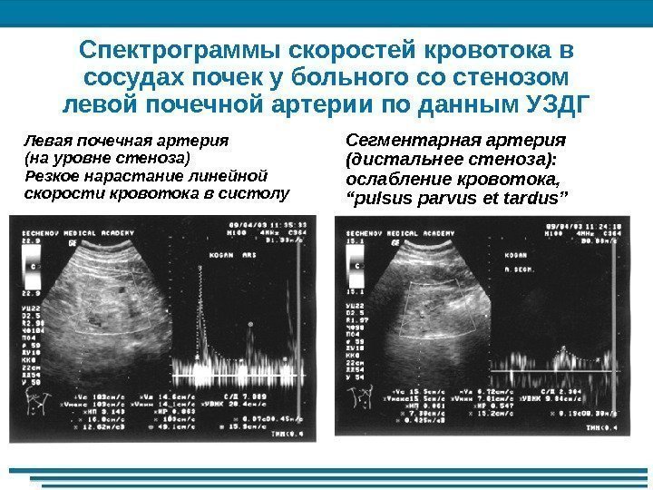 Спектрограммы скоростей кровотока в сосудах почек у больного со стенозом левой почечной артерии по