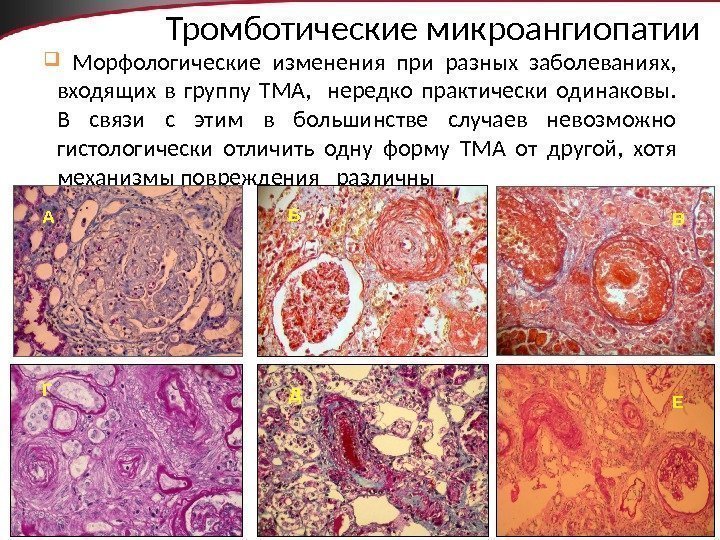 11 Тромботические микроангиопатии  Морфологические изменения при разных заболеваниях,  входящих в группу ТМА,