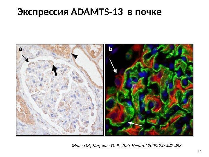 17 Экспрессия ADAMTS-13 в почке Manea M, Karpman D. Pediatr Nephrol 2009: 24; 447
