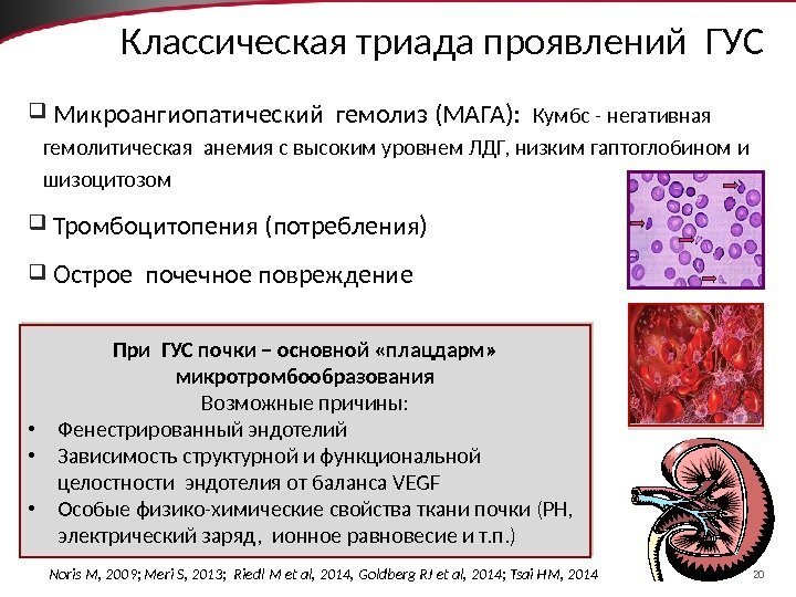 20 Классическая триада проявлений ГУС  Микроангиопатический гемолиз (МАГА):  Кумбс - негативная гемолитическая