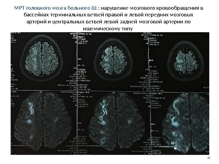 42 МРТ головного мозга больного Ш. : нарушение мозгового кровообращения в бассейнах терминальных ветвей