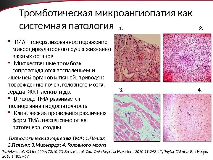9 Тромботическая микроангиопатия как системная патология  ТМА – генерализованное поражение микроциркуляторного русла жизненно