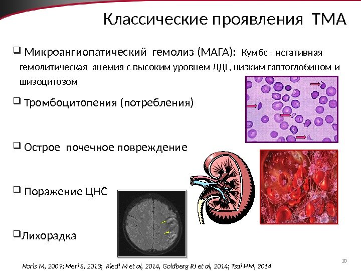 10 Классические проявления ТМА  Микроангиопатический гемолиз (МАГА):  Кумбс - негативная гемолитическая анемия