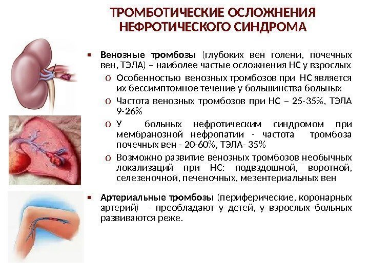  Венозные тромбозы  (глубоких вен голени,  почечных вен, ТЭЛА) – наиболее частые