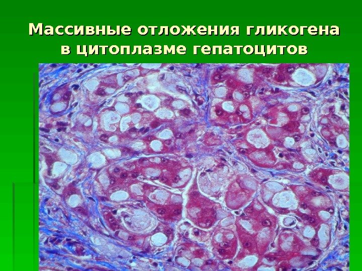 Массивные отложения гликогена в цитоплазме гепатоцитов  