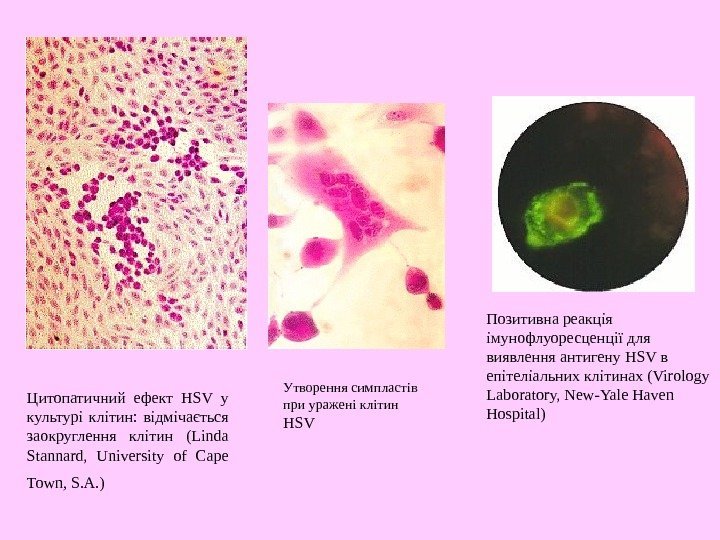 Цитопатичний ефект HSV у культурі клітин:  відмічається заокруглення клітин (Linda Stannard,  University