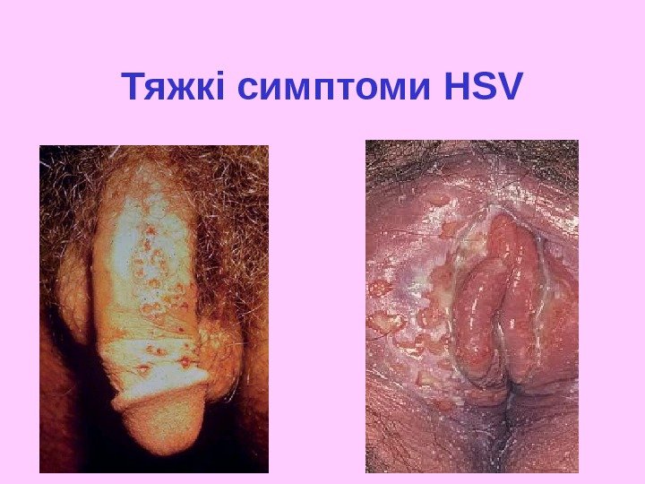 Тяжкі симптоми HSV 