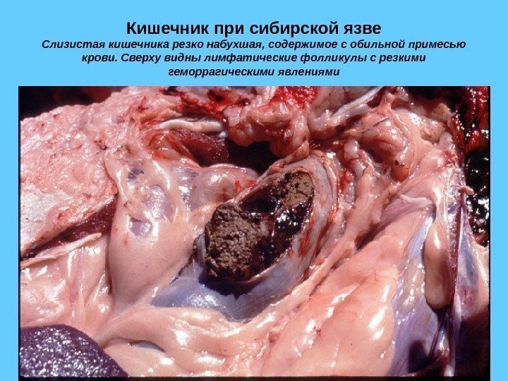 Кишечник при сибирской язве Слизистая кишечника резко набухшая, содержимое с обильной примесью крови. Сверху