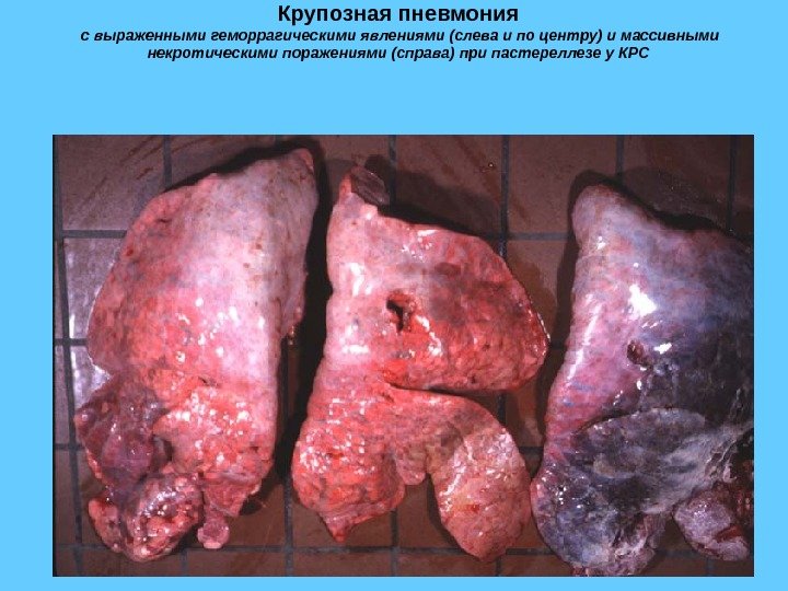 Крупозная пневмония  с выраженными геморрагическими явлениями (слева и по центру) и массивными некротическими
