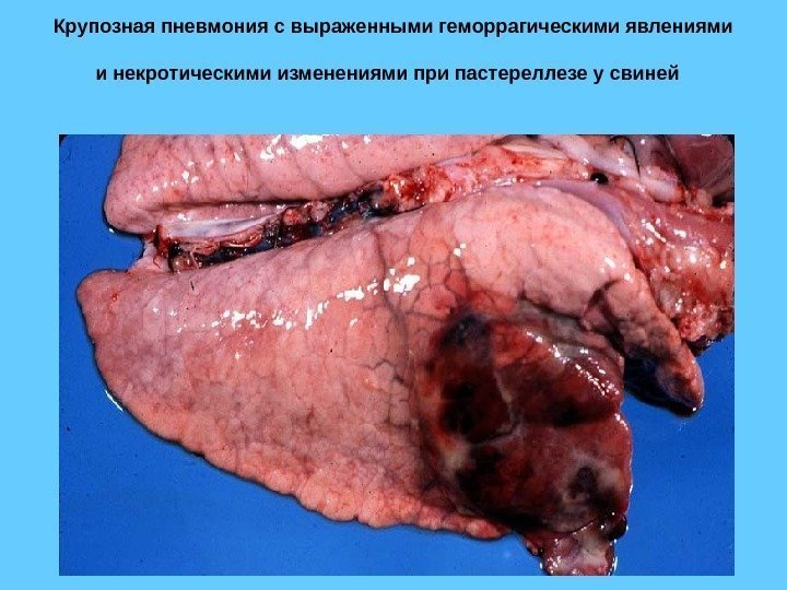 Крупозная пневмония с выраженными геморрагическими явлениями и некротическими изменениями при пастереллезе у свиней 