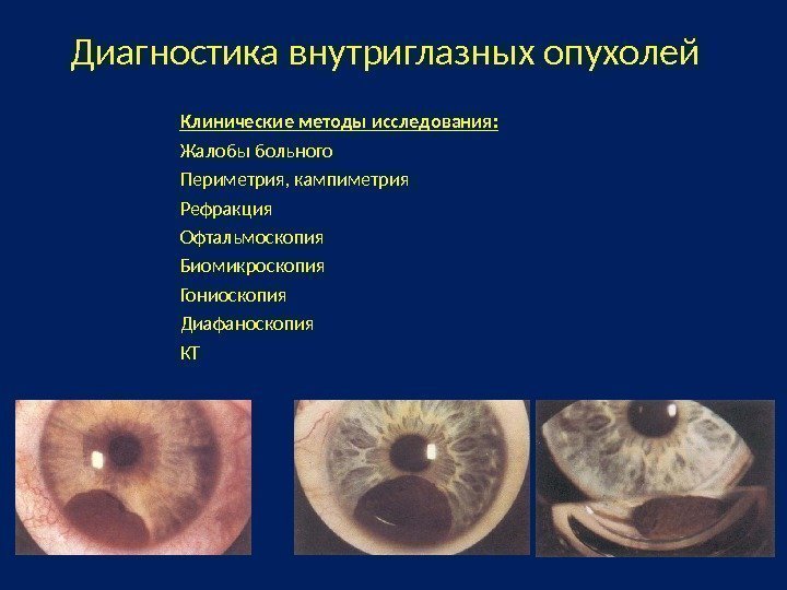 Диагностика внутриглазных опухолей Клинические методы исследования: Жалобы больного Периметрия, кампиметрия Рефракция Офтальмоскопия Биомикроскопия Гониоскопия