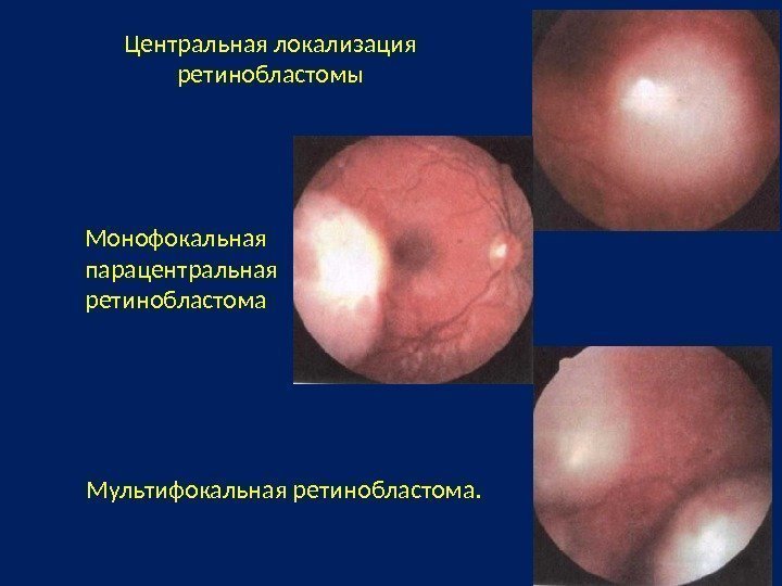 Центральная локализация ретинобластомы Монофокальная парацентральная ретинобластома Мультифокальная ретинобластома. 
