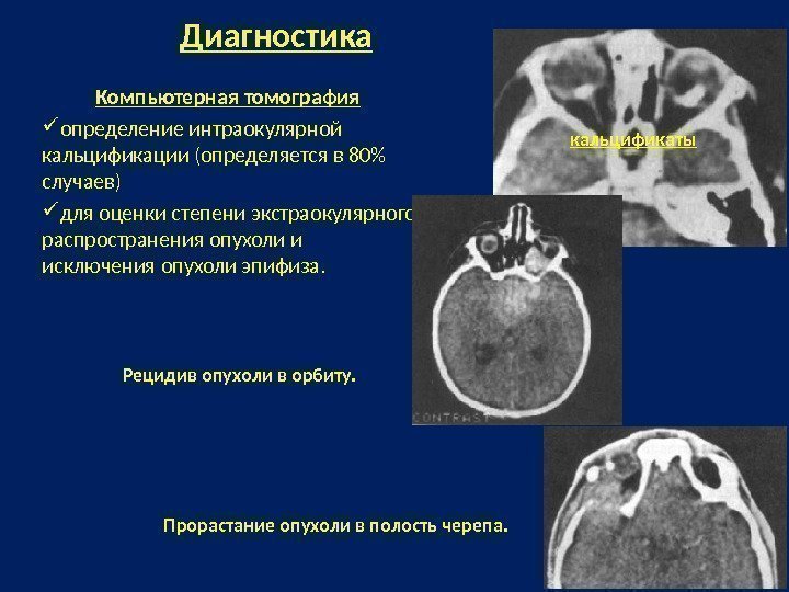 Диагностика Компьютерная томография  определение интраокулярной кальцификации (определяется в 80 случаев) для оценки степени