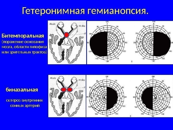  биназальная склероз внутренних сонных артерий Гетеронимная гемианопсия.  Битемпоральная (поражение основания мозга, области