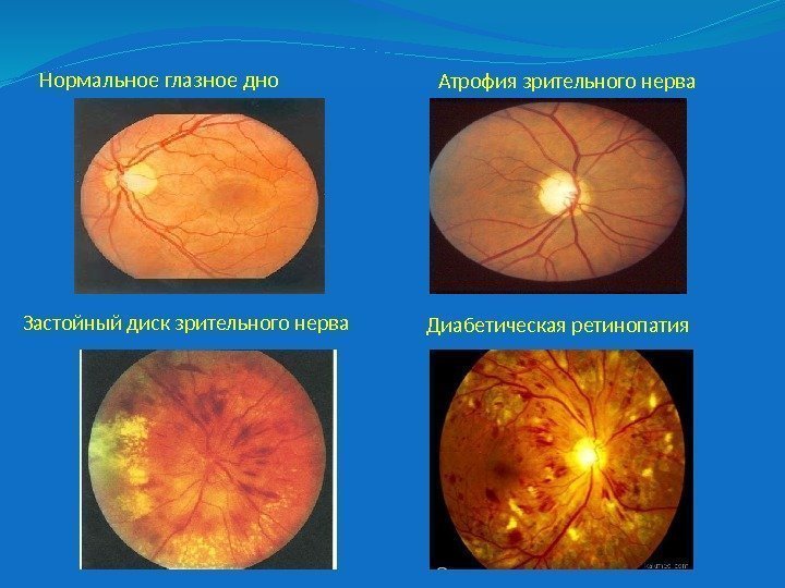 Нормальное глазное дно Застойный диск зрительного нерва Атрофия зрительного нерва Диабетическая ретинопатия 