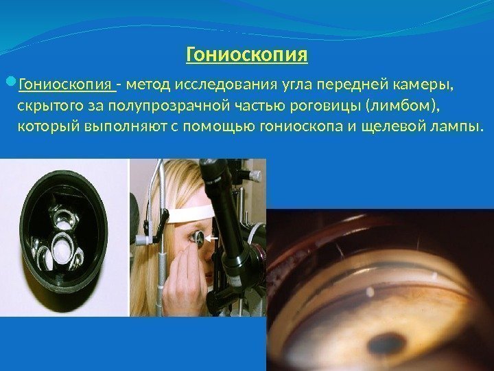 Гониоскопия - метод исследования угла передней камеры,  скрытого за полупрозрачной частью роговицы (лимбом),
