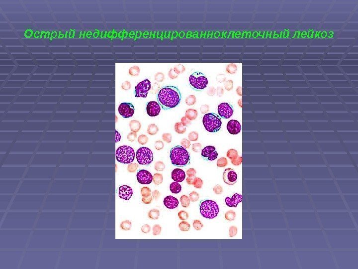 Острый недифференцированноклеточный лейкоз 