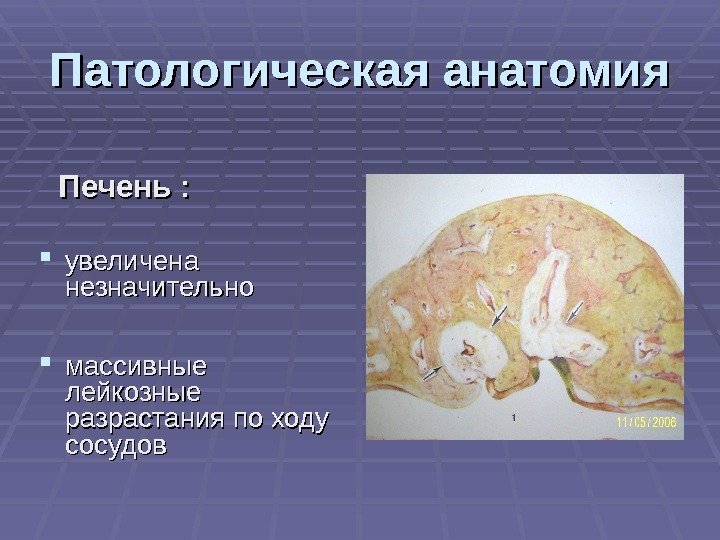 Патологическая анатомия  Печень :  увеличена незначительно  массивные лейкозные разрастания по ходу