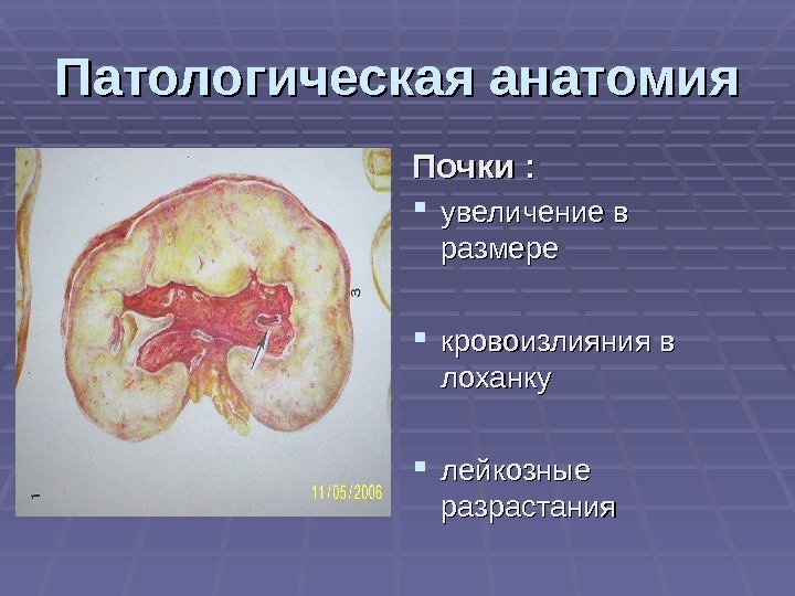Патологическая анатомия Почки :  увеличение в размере кровоизлияния в лоханку лейкозные разрастания 