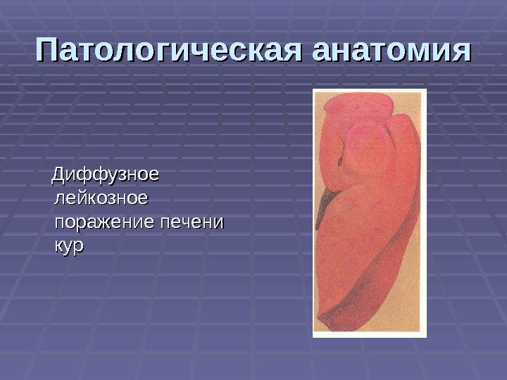 Патологическая анатомия  Диффузное лейкозное поражение печени куркур 