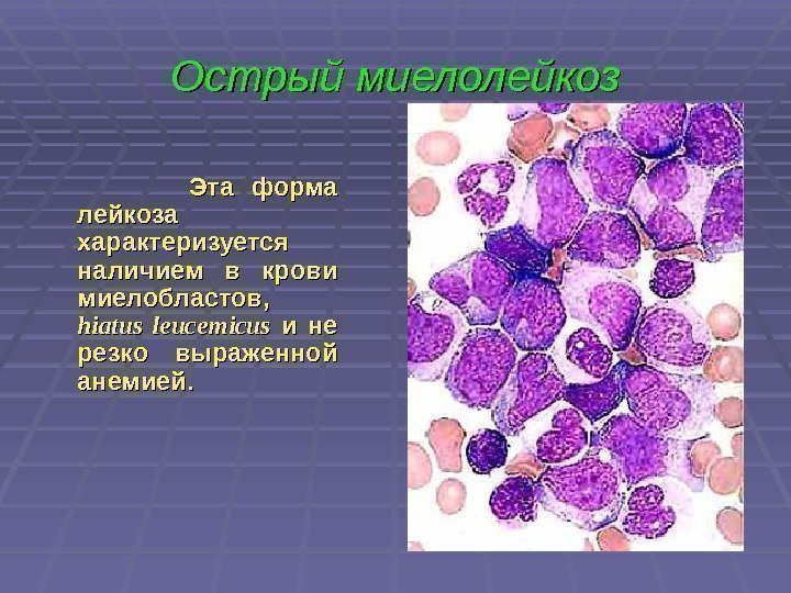 Острый миелолейкоз      Эта форма лейкоза характеризуется наличием в крови