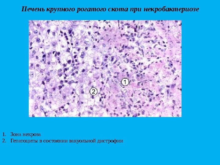 Печенькрупногорогатогоскотапринекробактериозе 1. Зона некроза 2. Гепатоциты в состоянии вакуольной дистрофии 