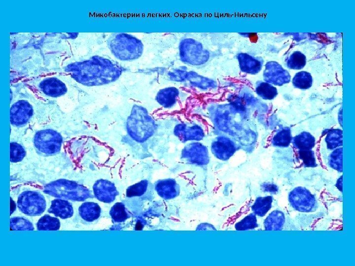 Микобактерии в легких. Окраска по Циль-Нильсену 