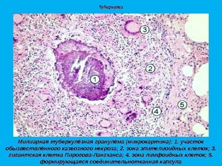 Туберкулез Милиарная туберкулёзная гранулёма (микрокартина): 1. участок обызвествлённого казеозного некроза; 2. зона эпителиоидных клеток;