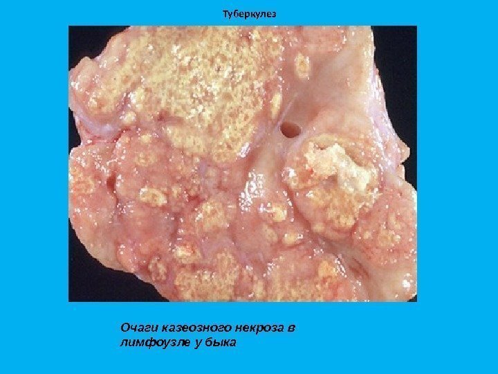 Туберкулез Очаги казеозного некроза в лимфоузле у быка 