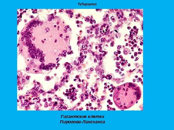 Туберкулез Гигантские клетки Пирогова-Лангханса 