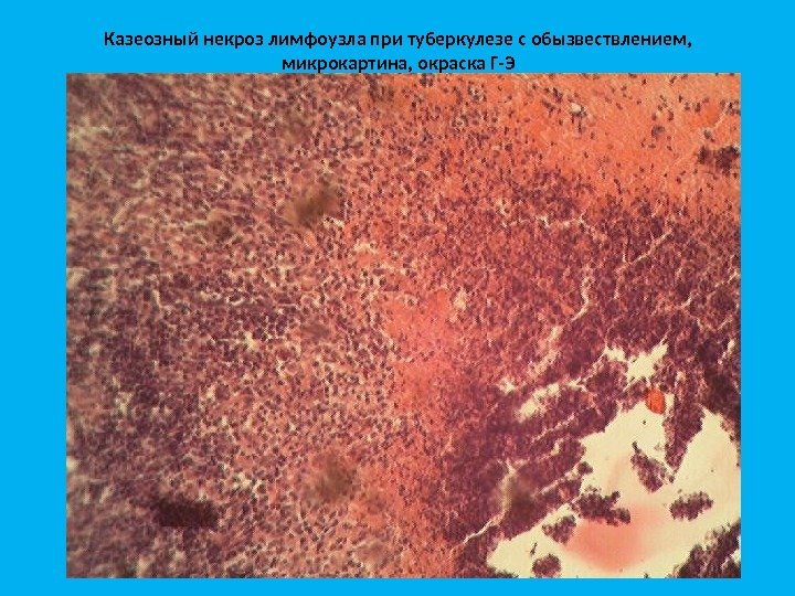 Казеозный некроз лимфоузла при туберкулезе с обызвествлением,  микрокартина, окраска Г-Э 
