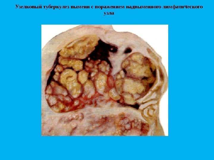 Узелковый туберкулез вымени с поражением надвыменного лимфатического узла 