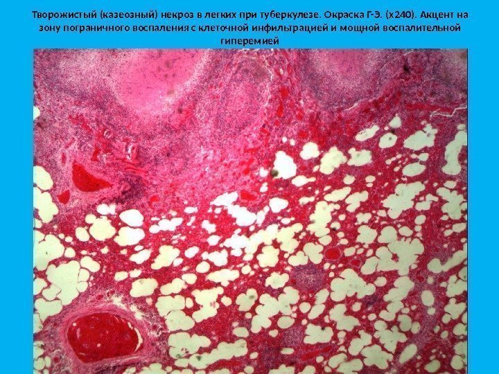Творожистый (казеозный) некроз в легких при туберкулезе. Окраска Г-Э. (х240). Акцент на зону пограничного