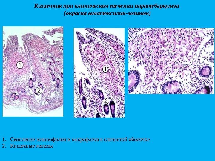Кишечникприклиническомтечениипаратуберкулеза (окраскагематоксилин-эозином) 1. Скопление эозинофилов и макрофагов в слизистой оболочке 2. Кишечные железы 