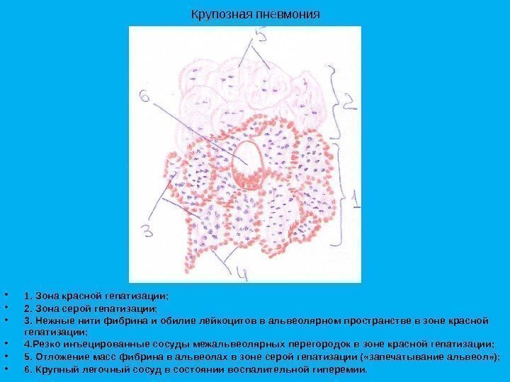 Крупозная пневмония • 1. Зона красной гепатизации;  • 2. Зона серой гепатизации; 