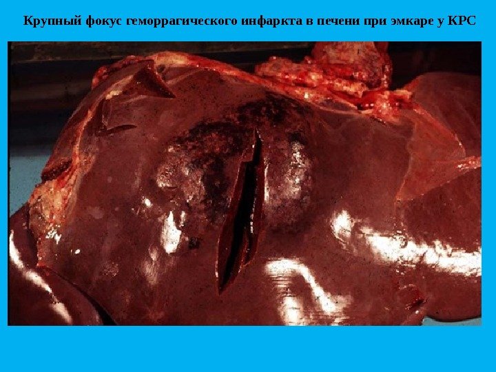 Крупный фокус геморрагического инфаркта в печени при эмкаре у КРС 