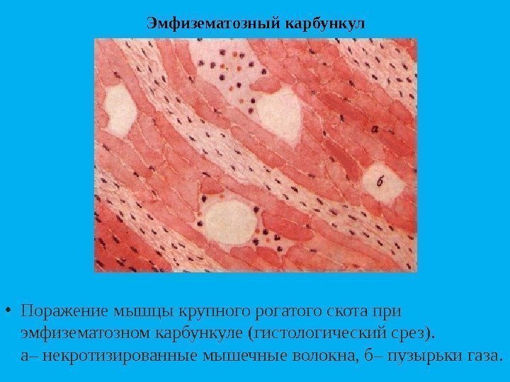 Эмфизематозный карбункул • Поражениемышцыкрупногорогатогоскотапри эмфизематозномкарбункуле(гистологическийсрез). а–некротизированныемышечныеволокна, б–пузырькигаза. 