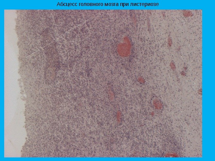 Абсцесс головного мозга при листериозе 
